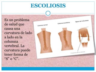 ESCOLIOSIS
Es un problema
de salud que
causa una
curvatura de lado
a lado en la
columna
vertebral. La
curvatura puede
tener forma de
“S” o “C”.
 