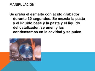 MANIPULACIÓN

Se graba el esmalte con ácido grabador
  durante 30 segundos. Se mezcla la pasta
  y el líquido base y la pasta y el líquido
  del catalizador, se unen y las
  condensamos en la cavidad y se pulen.
 