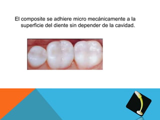 El composite se adhiere micro mecánicamente a la
   superficie del diente sin depender de la cavidad.
 