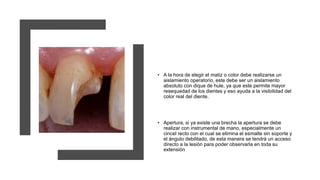• A la hora de elegir el matiz o color debe realizarse un
aislamiento operatorio, este debe ser un aislamiento
absoluto con dique de hule, ya que este permite mayor
resequedad de los dientes y eso ayuda a la visibilidad del
color real del diente.
• Apertura, si ya existe una brecha la apertura se debe
realizar con instrumental de mano, especialmente un
cincel recto con el cual se elimina el esmalte sin soporte y
el ángulo debilitado, de esta manera se tendrá un acceso
directo a la lesión para poder observarla en toda su
extensión
 