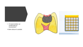 • El material deber ser
condensado en
incrementos*.
• Sobre obturar la cavidad.
 