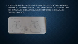 • 3. SE ELIMINA UNA CANTIDAD UNIFORME DE SUSTANCIA DENTINARIA
PERIFERICA, DE MANER QUE LA CAPA EXTERIOR DE LA AMALGAMA NO
SEA DEMASIADO DELGADA EN ALGUNOS LUGARES O DEMASIADO
GRUESA EN OTROS.
 