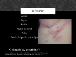 Impétigo Vulgar | PPTX
