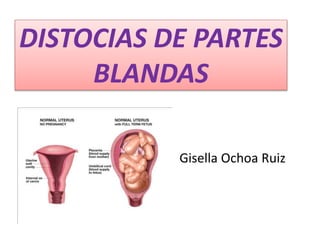 DISTOCIAS DE PARTES
BLANDAS
Gisella Ochoa Ruiz
 