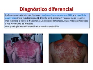 Diagnóstico diferencial
R(x) cutáneas inducidas por fármacos, síndrome Stevens-Johnson (SSJ) y la necrólisis
epidérmica: inicio más temprano (1-3 frente a 2-6 semanas) y exantema se resuelve
más rápido (1-3 frente a 2-6 semanas), no existe edema facial, bulas más características
y hay > involucro de mucosas.
Histopatología: necrólisis epidérmica y no hay eosinofilia.
R(x) cutáneas inducidas por fármacos, síndrome Stevens-Johnson (SSJ) y la necrólisis
epidérmica: inicio más temprano (1-3 frente a 2-6 semanas) y exantema se resuelve
más rápido (1-3 frente a 2-6 semanas), no existe edema facial, bulas más características
y hay > involucro de mucosas.
Histopatología: necrólisis epidérmica y no hay eosinofilia.
 