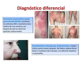Diagnóstico diferencial
Pustulosis exantemática aguda
generalizada (PEAG): comienzo
en primeras 48 h; exantema dura
menos de una semana y en
biopsia de piel se observan
pústulas subcorneales.
Pustulosis exantemática aguda
generalizada (PEAG): comienzo
en primeras 48 h; exantema dura
menos de una semana y en
biopsia de piel se observan
pústulas subcorneales.
Pseudolinfoma inducido por medicamentos: cuadro
clínico varios meses después. No fiebre, edema facial,
bulas ni involucro de mucosas y no afección hepática
ni eosinofilia.
Pseudolinfoma inducido por medicamentos: cuadro
clínico varios meses después. No fiebre, edema facial,
bulas ni involucro de mucosas y no afección hepática
ni eosinofilia.
 