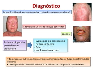 La > rash cutáneo (rash maculopapluar, rash eritematoso generalizado)La > rash cutáneo (rash maculopapluar, rash eritematoso generalizado)
Edema facial (marcado en regió periorbital)Edema facial (marcado en regió periorbital)
QueilitisQueilitis
Diagnóstico
Rash maculopapular
generalmente
pruriginoso
Rash maculopapular
generalmente
pruriginoso
- Evoluciona a la eritrodermia
- Pústulas estériles
- Bulas
- Involucro de mucosas
- Evoluciona a la eritrodermia
- Pústulas estériles
- Bulas
- Involucro de mucosas
 Cara, tronco y extremidades superiores: primeros afectados, luego las extremidades
inferiores.
 100 % pacientes: involucro más del 50 % del área de la superficie corporal total.
 Cara, tronco y extremidades superiores: primeros afectados, luego las extremidades
inferiores.
 100 % pacientes: involucro más del 50 % del área de la superficie corporal total.
 