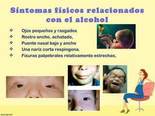 Síntomas físicos relacionados
con el alcohol
 Ojos pequeños y rasgados
 Rostro ancho, achatado,
 Puente nasal bajo y ancho
 Una nariz corta respingona.
 Fisuras palpebrales relativamente estrechas,
 