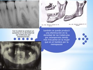 también se puede producir
una disminución en la
densidad de las trabéculas
por osteoporosis siendo
más frecuente en la mujer
que en el hombre por la
menopausia
Con la edad se produce un
aumento en la densidad de
las trabéculas por
osteoesclerosis
 