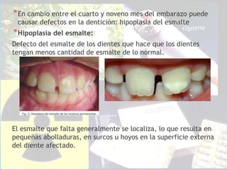 *En cambio entre el cuarto y noveno mes del embarazo puede
causar defectos en la dentición: hipoplasia del esmalte
*Hipoplasia del esmalte:
Defecto del esmalte de los dientes que hace que los dientes
tengan menos cantidad de esmalte de lo normal.
El esmalte que falta generalmente se localiza, lo que resulta en
pequeñas abolladuras, en surcos u hoyos en la superficie externa
del diente afectado.
 