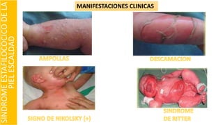 SINDROMEESTAFILOCOCICODELA
PIELESCALDAD
MANIFESTACIONES CLINICAS
 