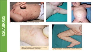 ESCABIOSIS
 