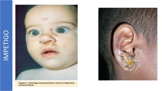 IMPETIGO
 