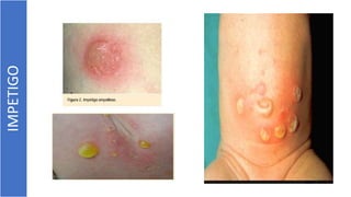 IMPETIGO
 