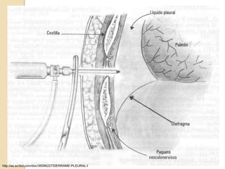 http://es.scribd.com/doc/36096227/DERRAME-PLEURAL-I
 