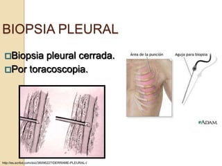 BIOPSIA PLEURAL
 Biopsia pleural cerrada.
 Por toracoscopia.




http://es.scribd.com/doc/36096227/DERRAME-PLEURAL-I
 