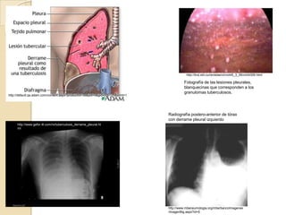 http://bvs.sld.cu/revistas/cir/vol45_3_06/cir04306.html

                                                                                         Fotografía de las lesiones pleurales,
                                                                                         blanquecinas que corresponden a los
                                                                                         granulomas tuberculosos.
http://default.qa.adam.com/content.aspx?productId=39&pid=5&gid=000125&print=1




                                                                                Radiografía postero-anterior de tórax
                                                                                con derrame pleural izquierdo
     http://www.gefor.4t.com/rx/tuberculosis_derrame_pleural.ht
     ml




                                                                                http://www.mbeneumologia.org/mbe/bancoImagenes
                                                                                /imagenBig.aspx?id=5
 