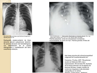 http://www.mbeneumologia.org/mbe/bancoImagenes/im    RUIZ RODRIGUEZ, F.. Tuberculosis diseminada con derrame pleural. Rev. esp.
agenBig.aspx?id=126                                  sanid. penit. [online]. 2010, vol.12, n.3, pp. 99-99. ISSN 1575-0620
                                                    Flechas pequenas: zonas de concentracion de lesiones
Radiografía postero-anterior de tórax               micronodulares “en grano de mijo”. Flechas grandes: limites del
derrame pleural subpulmonar derecho.                derrame pleural.
Se aprecia elevación del hemidiafragma,
con lateralización de la cúpula
diafragmática y medialización del seno
costofrénico derecho.



                                                                               http://www.cpicmha.sld.cu/bvs/monografias/I
                                                                               magenesFrecTorax/tematicas/tb.htm

                                                                               Femenina. 75 años. APP: TB pulmonar,
                                                                               acude con fiebre de 38oC, tos y
                                                                               expectoración. RX de tórax PA. Aumento
                                                                               de la trama pulmonar con el aspecto de
                                                                               lesiones fibrosas. Imagen nodular de
                                                                               contornos irregulares y alta densidad
                                                                               radiográfica en el vértice
 