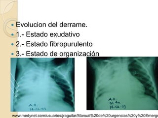  Evolucion del derrame.
 1.- Estado exudativo
 2.- Estado fibropurulento
 3.- Estado de organización




www.medynet.com/usuarios/jraguilar/Manual%20de%20urgencias%20y%20Emerge
 