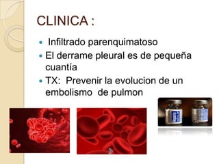 CLINICA :
  Infiltrado parenquimatoso
 El derrame pleural es de pequeña
  cuantía
 TX: Prevenir la evolucion de un
  embolismo de pulmon
 