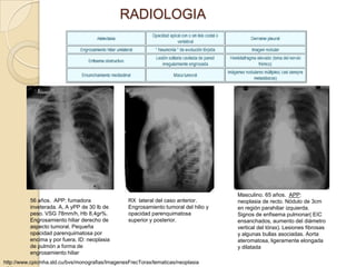 RADIOLOGIA




                                                                                      Masculino. 65 años. APP:
          56 años. APP: fumadora                  RX lateral del caso anterior.       neoplasia de recto. Nódulo de 3cm
          inveterada. A, A yPP de 30 lb de        Engrosamiento tumoral del hilio y   en región parahiliar izquierda.
          peso. VSG 78mm/h, Hb 8,4gr%.            opacidad parenquimatosa             Signos de enfisema pulmonar( EIC
          Engrosamiento hiliar derecho de         superior y posterior.               ensanchados, aumento del diámetro
          aspecto tumoral. Pequeña                                                    vertical del tórax). Lesiones fibrosas
          opacidad parenquimatosa por                                                 y algunas bullas asociadas. Aorta
          encima y por fuera. ID: neoplasia                                           ateromatosa, ligeramente elongada
          de pulmón a forma de                                                        y dilatada
          engrosamiento hiliar
http://www.cpicmha.sld.cu/bvs/monografias/ImagenesFrecTorax/tematicas/neoplasia
 