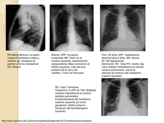 RX lateral derecha. La lesión         60años. APP: fumadora                      Fem. 54 años. APP: mastectomía
     ocupa el mediastino medio y           inveterada. MC: Dolor en el                derecha hace 2 años. MC: disnea:
     anterior. ID: neoplasia de            hombro izquierdo, expectoración            EF: MV ligeramente
     pulmón a forma mediastinal.           sanguinolenta. Masa tumoral en el          disminuido. RX tórax PA rotada. Alg
     DD: linfoma                           vértice izquierdo. Lisis del arco          unos nódulos metastásicos en ambos
                                           posterior de la 3ra y 4ta                  campos pulmonares. Llama la
                                           costillas. Tumor de Pancoast.              atención el contorno del mediastino
                                                                                      superior izquierdo.



                                               RX a las 7 semanas.
                                               Presenta A, A yPP de 10lb. Múltiples
                                               nódulos metastásicos en ambos
                                               campos pulmonares.
                                               Ensanchamiento del mediastino
                                               superior izquierdo por toma
                                               ganglionar. Doble contorno.
                                               Elevación del hemidiafragma
                                               izquierdo.


http://www.cpicmha.sld.cu/bvs/monografias/ImagenesFrecTorax/tematicas/neoplasia
 