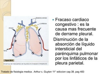  Fracaso cardiaco
                                                congestivo : es la
                                                causa mas frecuente
                                                de derrame pleural.
                                               Disminución de la
                                                absorción de líquido
                                                intersticial del
                                                parénquima pulmonar
                                                por los linfáticos de la
                                                pleura parietal.
Tratado de fisiologia medica . Arthur c. Guyton 11° ediccion cap.38. pag 483
 