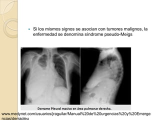    Si los mismos signos se asocian con tumores malignos, la
                enfermedad se denomina síndrome pseudo-Meigs




www.medynet.com/usuarios/jraguilar/Manual%20de%20urgencias%20y%20Emerge
ncias/derrapleu
 
