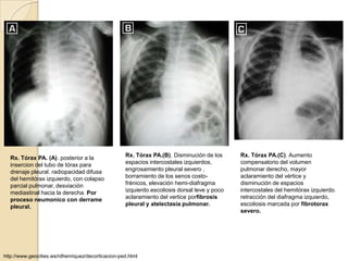 Rx. Tórax PA. (A). posterior a la                 Rx. Tórax PA.(B). Disminución de los      Rx. Tórax PA.(C). Aumento
  insercion del tubo de tórax para                  espacios intercostales izquierdos,        compensatorio del volumen
  drenaje pleural. radiopacidad difusa              engrosamiento pleural severo ,            pulmonar derecho, mayor
  del hemitórax izquierdo, con colapso              borramiento de los senos costo-           aclaramiento del vértice y
  parcial pulmonar, desviación                      frénicos, elevación hemi-diafragma        disminución de espacios
  mediastinal hacia la derecha. Por                 izquierdo.escoliosis dorsal leve y poco   intercostales del hemitórax izquierdo.
  proceso neumonico con derrame                     aclaramiento del vertice porfibrosis      retracción del diafragma izquierdo,
  pleural.                                          pleural y atelectasia pulmonar.           escoliosis marcada por fibrotorax
                                                                                              severo.




http://www.geocities.ws/rdhenriquez/decorticacion-ped.html
 