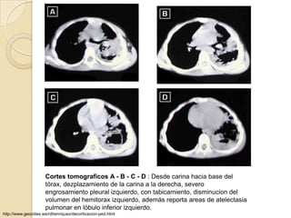 Cortes tomograficos A - B - C - D : Desde carina hacia base del
                     tórax, dezplazamiento de la carina a la derecha, severo
                     engrosamiento pleural izquierdo, con tabicamiento, disminucion del
                     volumen del hemitorax izquierdo, además reporta areas de atelectasia
                     pulmonar en lóbulo inferior izquierdo.
http://www.geocities.ws/rdhenriquez/decorticacion-ped.html
 