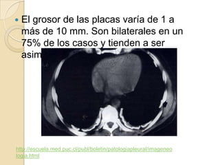    El grosor de las placas varía de 1 a
    más de 10 mm. Son bilaterales en un
    75% de los casos y tienden a ser
    asimétricas.




http://escuela.med.puc.cl/publ/boletin/patologiapleural/imageneo
logia.html
 