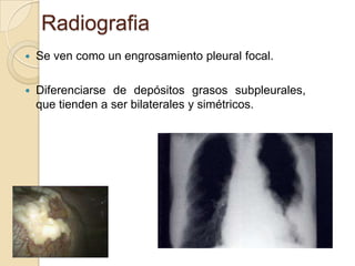 Radiografia
   Se ven como un engrosamiento pleural focal.

   Diferenciarse de depósitos grasos subpleurales,
    que tienden a ser bilaterales y simétricos.
 