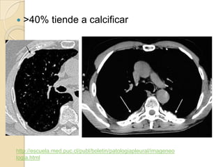    >40% tiende a calcificar




http://escuela.med.puc.cl/publ/boletin/patologiapleural/imageneo
logia.html
 