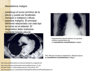 Mesotelioma maligno

       constituye el tumor primitivo de la
       pleura y puede ser localizado
       (benigno o maligno) o difuso
       (siempre maligno). El principal
       elemento relacionado con este tipo
       de tumor es el asbesto. El
       diagnóstico debe realizarse
       mediante biopsia pleural.

                                                                                 Engrosamiento pleural extenso con gruesos
                                                                                 nódulos característicos de
                                                                                 un mesotelioma (mesothelioma) maligno




                                                                        TAC: Afección de pleura mediastínica. Nódulos típicos
                                                                        de mesotelioma (mesothelioma) maligno


http://www.portalesmedicos.com/servs/mesotelioma_imagenes.htm
http://www.intramed.net/sitios/librovirtual1/pdf/librovirtual1_21.pdf
Hinshaw-Corwin H. enfermedades del torax 3era edicion: 631
http://escuela.med.puc.cl/publ/boletin/PatologiaPleural/DerramePleuralNeoplasico.ht
 