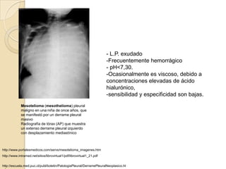 - L.P. exudado
                                                                        -Frecuentemente hemorrágico
                                                                        - pH<7,30.
                                                                        -Ocasionalmente es viscoso, debido a
                                                                        concentraciones elevadas de ácido
                                                                        hialurónico,
                                                                        -sensibilidad y especificidad son bajas.
             Mesotelioma (mesothelioma) pleural
             maligno en una niña de once años, que
             se manifestó por un derrame pleural
             masivo
             Radiografía de tórax (AP) que muestra
             un extenso derrame pleural izquierdo
             con desplazamiento mediastínico



http://www.portalesmedicos.com/servs/mesotelioma_imagenes.htm
http://www.intramed.net/sitios/librovirtual1/pdf/librovirtual1_21.pdf


http://escuela.med.puc.cl/publ/boletin/PatologiaPleural/DerramePleuralNeoplasico.ht
 