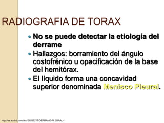 RADIOGRAFIA DE TORAX
                      No se puede detectar la etiología del
                       derrame
                      Hallazgos: borramiento del ángulo
                       costofrénico u opacificación de la base
                       del hemitórax.
                      El líquido forma una concavidad
                       superior denominada Menisco Pleural.



http://es.scribd.com/doc/36096227/DERRAME-PLEURAL-I
 