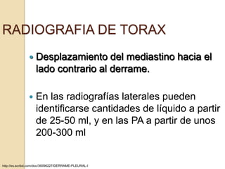 RADIOGRAFIA DE TORAX
                  Desplazamiento del mediastino hacia el
                   lado contrario al derrame.

                  En las radiografías laterales pueden
                   identificarse cantidades de líquido a partir
                   de 25-50 ml, y en las PA a partir de unos
                   200-300 ml


http://es.scribd.com/doc/36096227/DERRAME-PLEURAL-I
 
