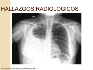HALLAZGOS RADIOLOGICOS




http://es.scribd.com/doc/36096227/DERRAME-PLEURAL-I
 