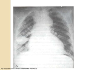 http://es.scribd.com/doc/36096227/DERRAME-PLEURAL-I
 
