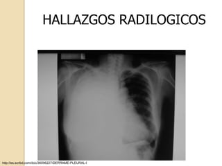 HALLAZGOS RADILOGICOS




http://es.scribd.com/doc/36096227/DERRAME-PLEURAL-I
 