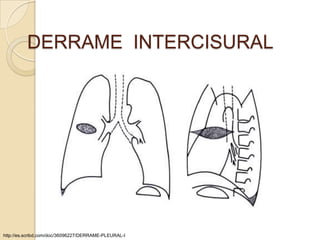 DERRAME INTERCISURAL




http://es.scribd.com/doc/36096227/DERRAME-PLEURAL-I
 