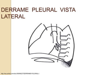 DERRAME PLEURAL VISTA
LATERAL




http://es.scribd.com/doc/36096227/DERRAME-PLEURAL-I
 