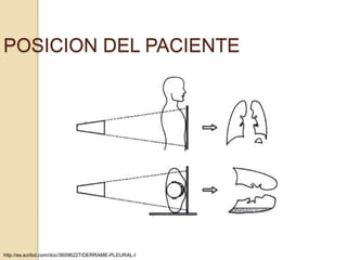 POSICION DEL PACIENTE




http://es.scribd.com/doc/36096227/DERRAME-PLEURAL-I
 