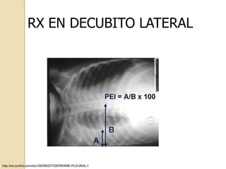 RX EN DECUBITO LATERAL




http://es.scribd.com/doc/36096227/DERRAME-PLEURAL-I
 