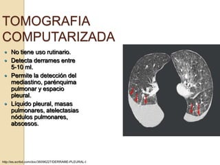 TOMOGRAFIA
COMPUTARIZADA
    No tiene uso rutinario.
    Detecta derrames entre
     5-10 ml.
    Permite la detección del
     mediastino, parénquima
     pulmonar y espacio
     pleural.
    Líquido pleural, masas
     pulmonares, atelectasias
     nódulos pulmonares,
     abscesos.




http://es.scribd.com/doc/36096227/DERRAME-PLEURAL-I
 