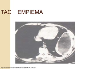 TAC                     EMPIEMA




http://es.scribd.com/doc/36096227/DERRAME-PLEURAL-I
 