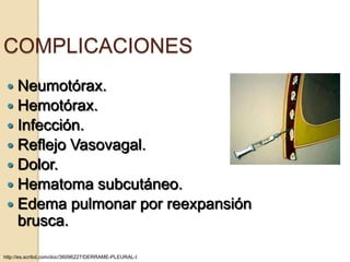 COMPLICACIONES
  Neumotórax.
  Hemotórax.
  Infección.
  Reflejo Vasovagal.
  Dolor.
  Hematoma subcutáneo.
  Edema pulmonar por reexpansión
   brusca.

http://es.scribd.com/doc/36096227/DERRAME-PLEURAL-I
 