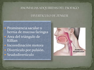  Prominencia sacular o
hernia de mucosa faríngea
 Area del triángulo de
Killian
 Incoordinación motora
 Divertículo por pulsión.
 Seudodiverticulo
 