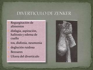  Regurgitación de
alimentos
 disfagia, aspiración,
halitosis y edema de
cuello
 tos, disfonía, neumonia
 deglución ruidosa
 Bezoares
 Ulcera del divertículo
 