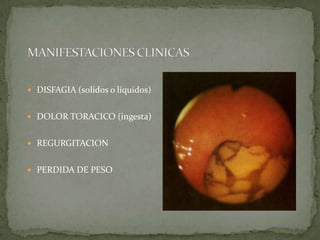  DISFAGIA (solidos o líquidos)
 DOLOR TORACICO (ingesta)
 REGURGITACION
 PERDIDA DE PESO
 